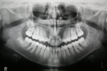 Fort Worth Dental X-Rays