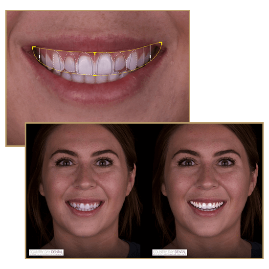 A before and after collage of a patient with smile design