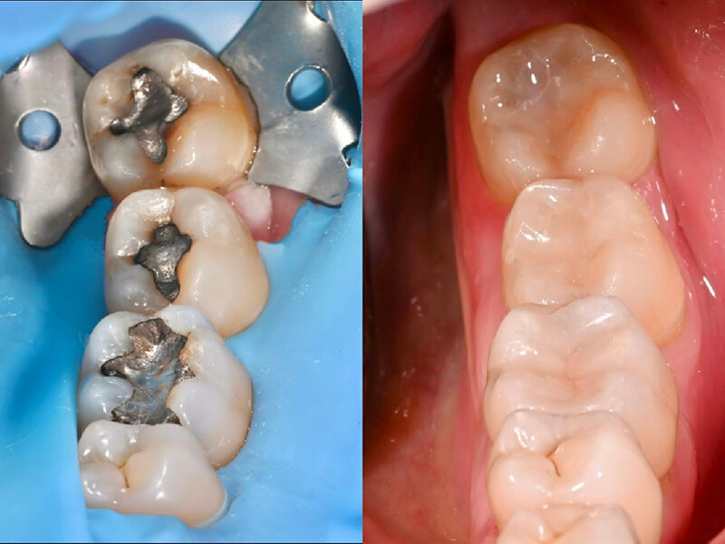 Close up of a mouth before and after restorative dentistry