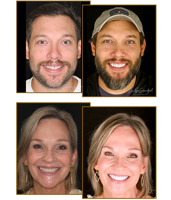 Veneers before and after in Fort Worth 
